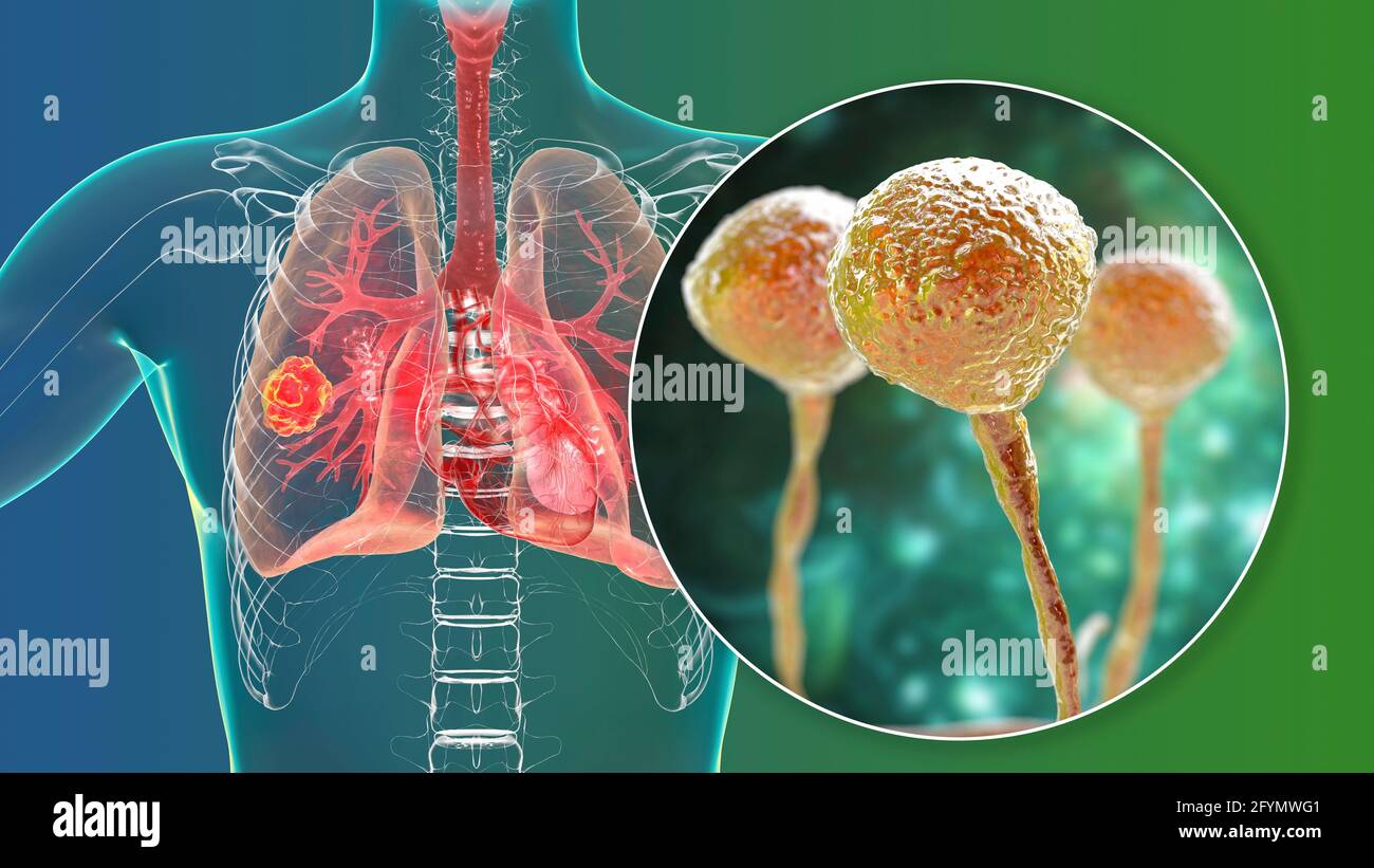 Mucormycose pulmonaire, illustration Banque D'Images