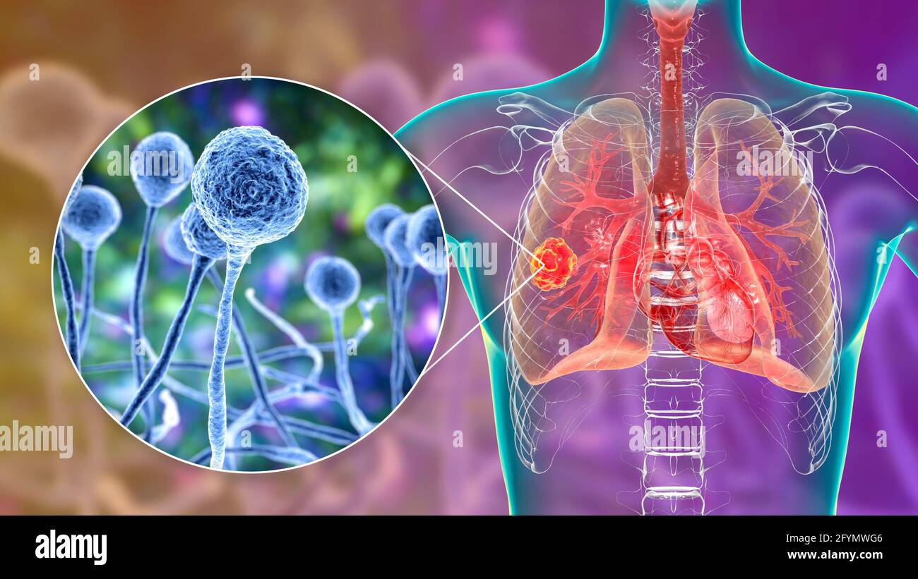 Mucormycose pulmonaire, illustration Banque D'Images