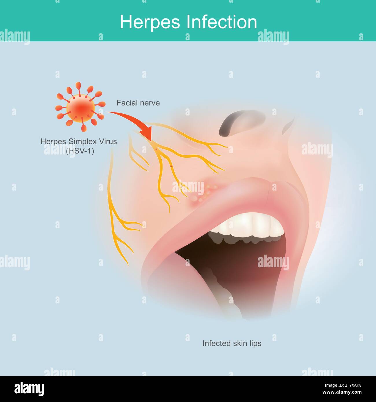 Infection à l'herpès. Illustration la peau du nerf facial humain à utiliser expliquer l'infection de lèvre du virus de l'herpès simplex. Illustration de Vecteur