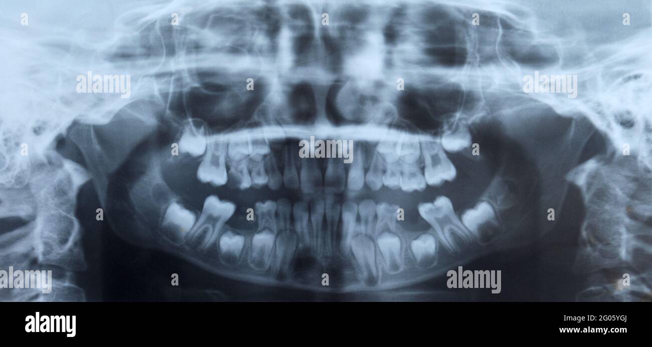 Radiographie dentaire d'un enfant Banque D'Images