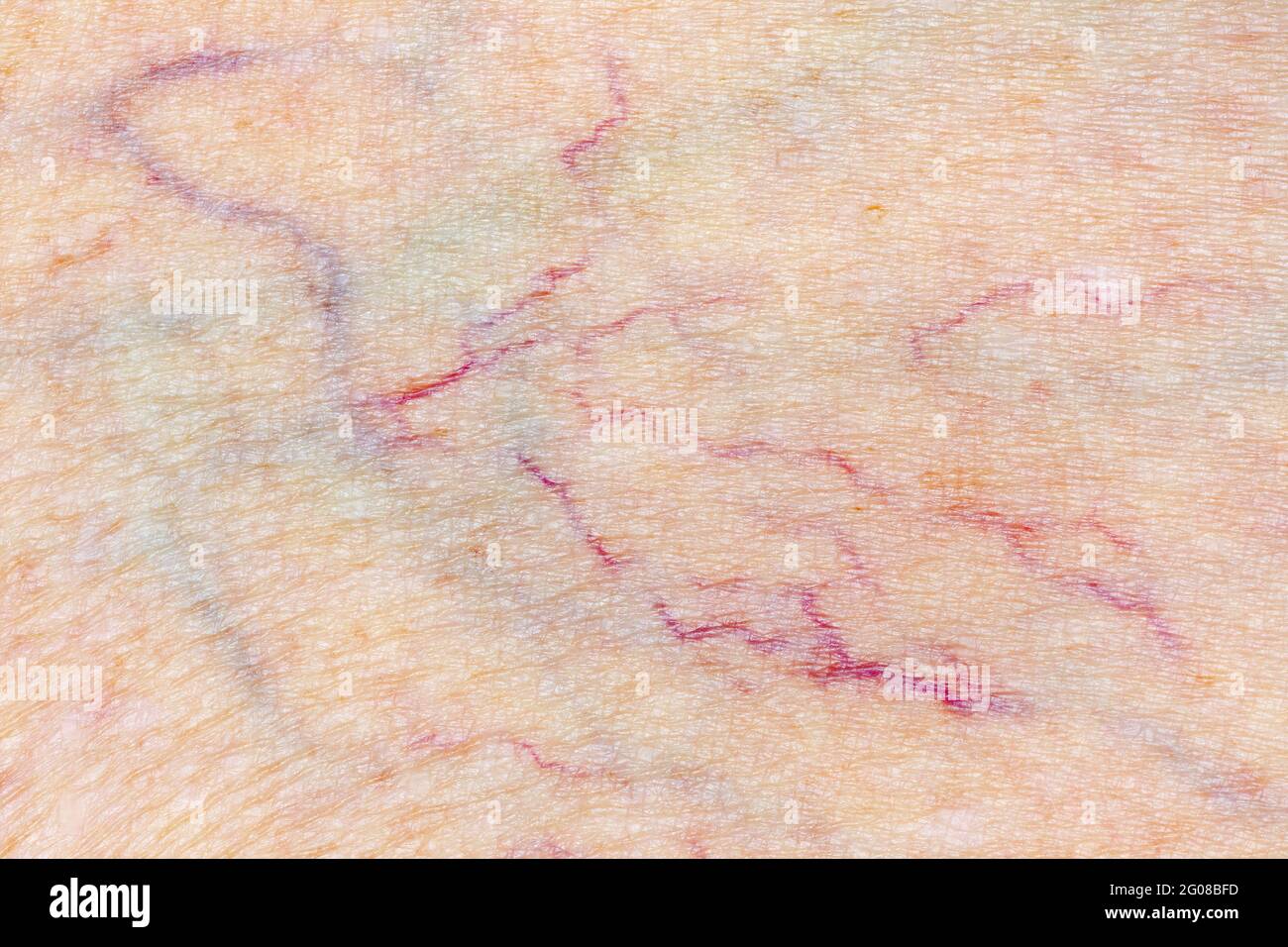 Veine variqueuse pour la phlébologie, l'examen de la peau et les soins de santé Macro photo Banque D'Images