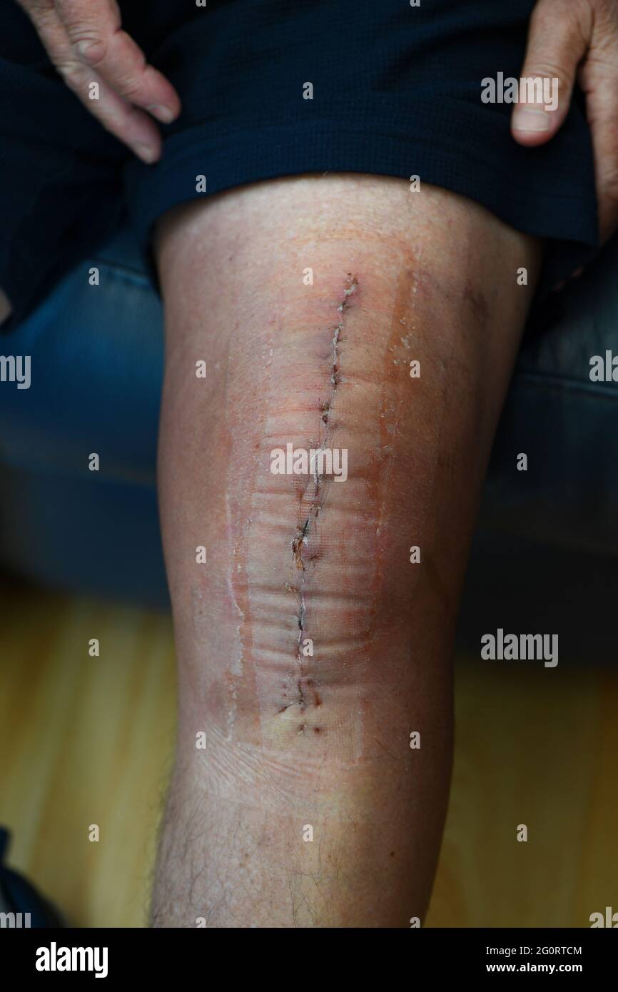 Gros plan de la jambe après l'opération de remplacement du genou montrant des points post-op deux semaines après l'opération. Banque D'Images
