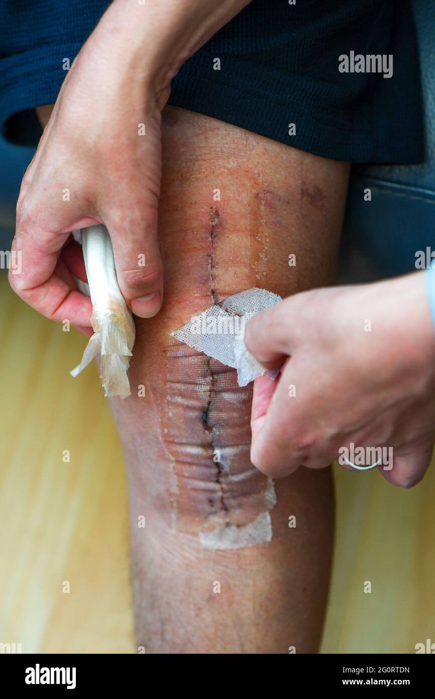 Gros plan de la jambe après l'opération de remplacement du genou montrant des points post-op deux semaines après l'opération. Banque D'Images