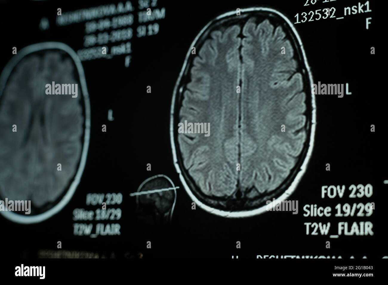 Gros plan de l'imagerie par résonance magnétique du cerveau humain Banque D'Images
