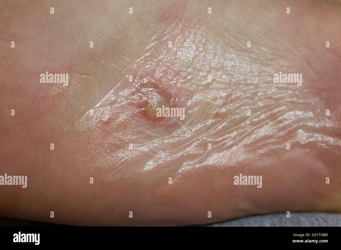 Eczéma dyshidrotique sur le pied. Dermatite de plaquette. Traité avec