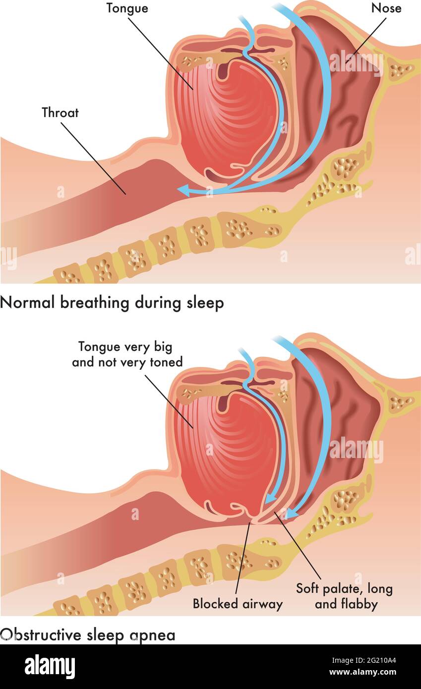 Illustration médicale des conséquences de l'apnée obstructive du sommeil. Illustration de Vecteur