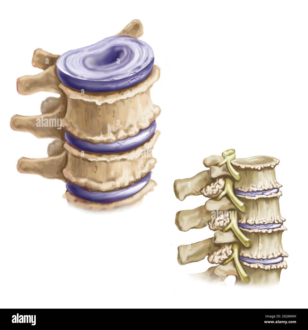 Perruques ostéoarthritiques sur la colonne vertébrale. Banque D'Images
