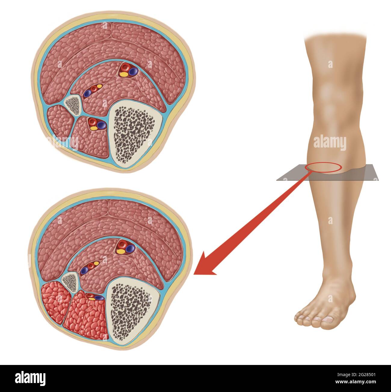 Partie inférieure de la jambe montrant la normale et la compression des compartiments latéraux et antérieurs. Banque D'Images