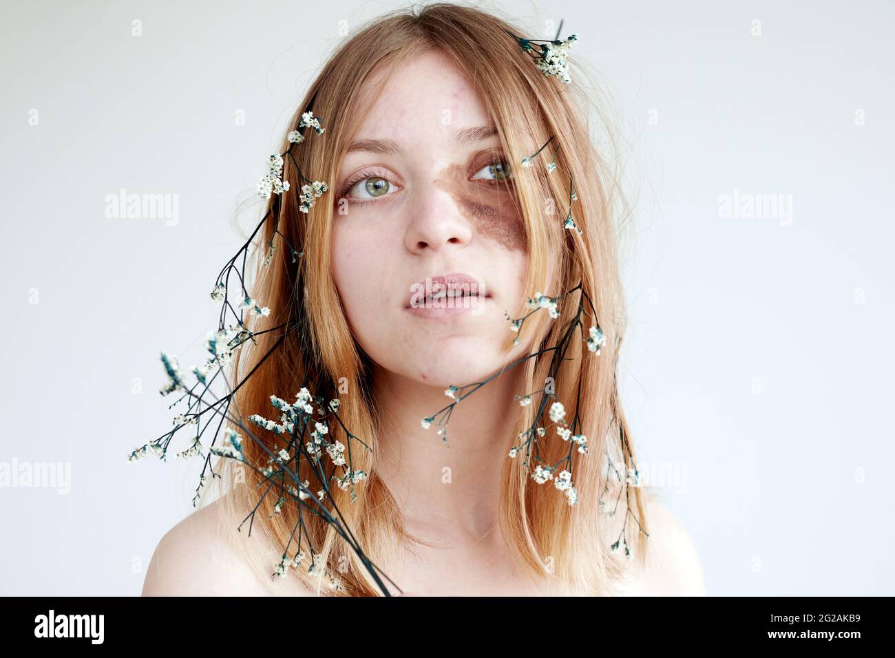 Jeune femme positive avec tache marron sur la peau du visage et des fleurs délicates dans les cheveux regardant vers le haut sur fond blanc Banque D'Images