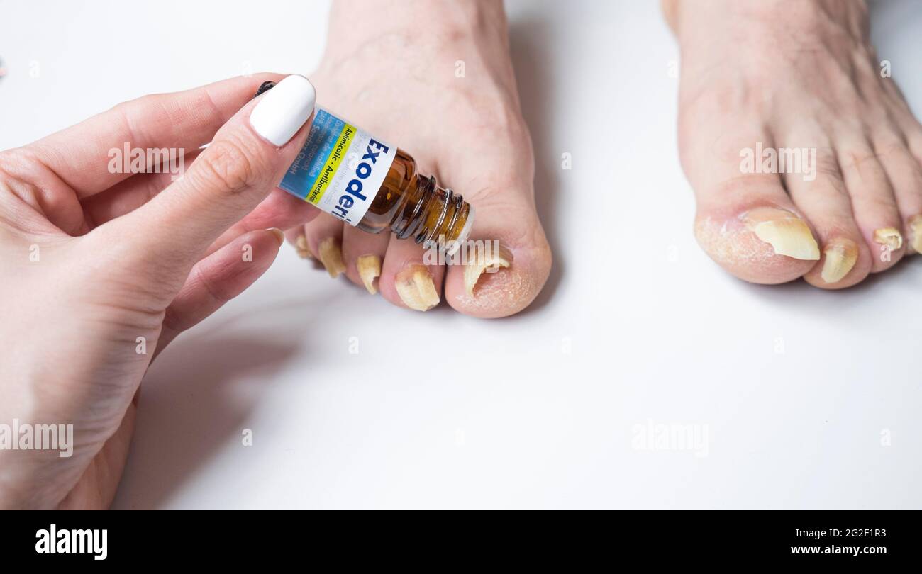 Avril 2021, Bucarest, Roumanie. La femme applique Exoderil, traitement de champignon de Nail aux ongles longs infectés de l'homme Banque D'Images