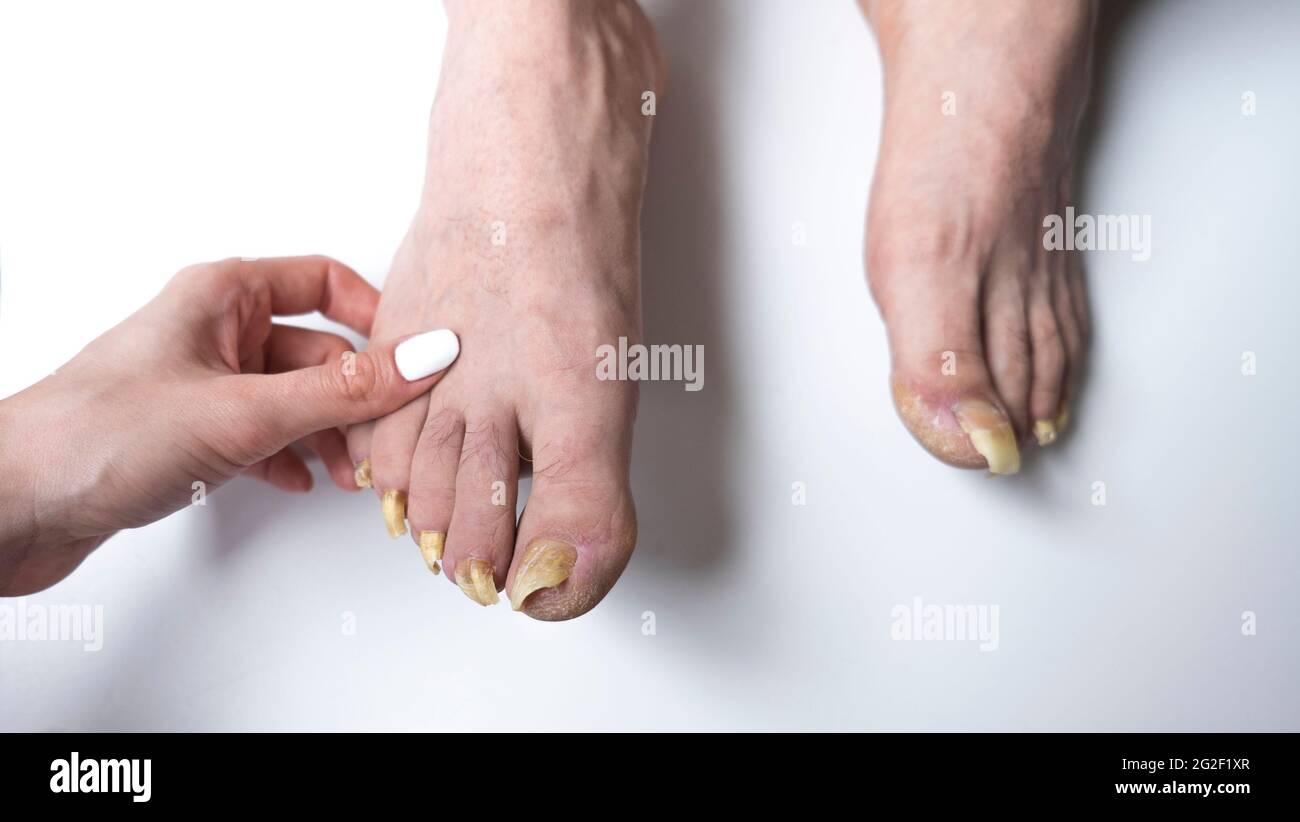 Les pieds de l'homme avec de longs ongles infectés par le champignon Photo  Stock - Alamy