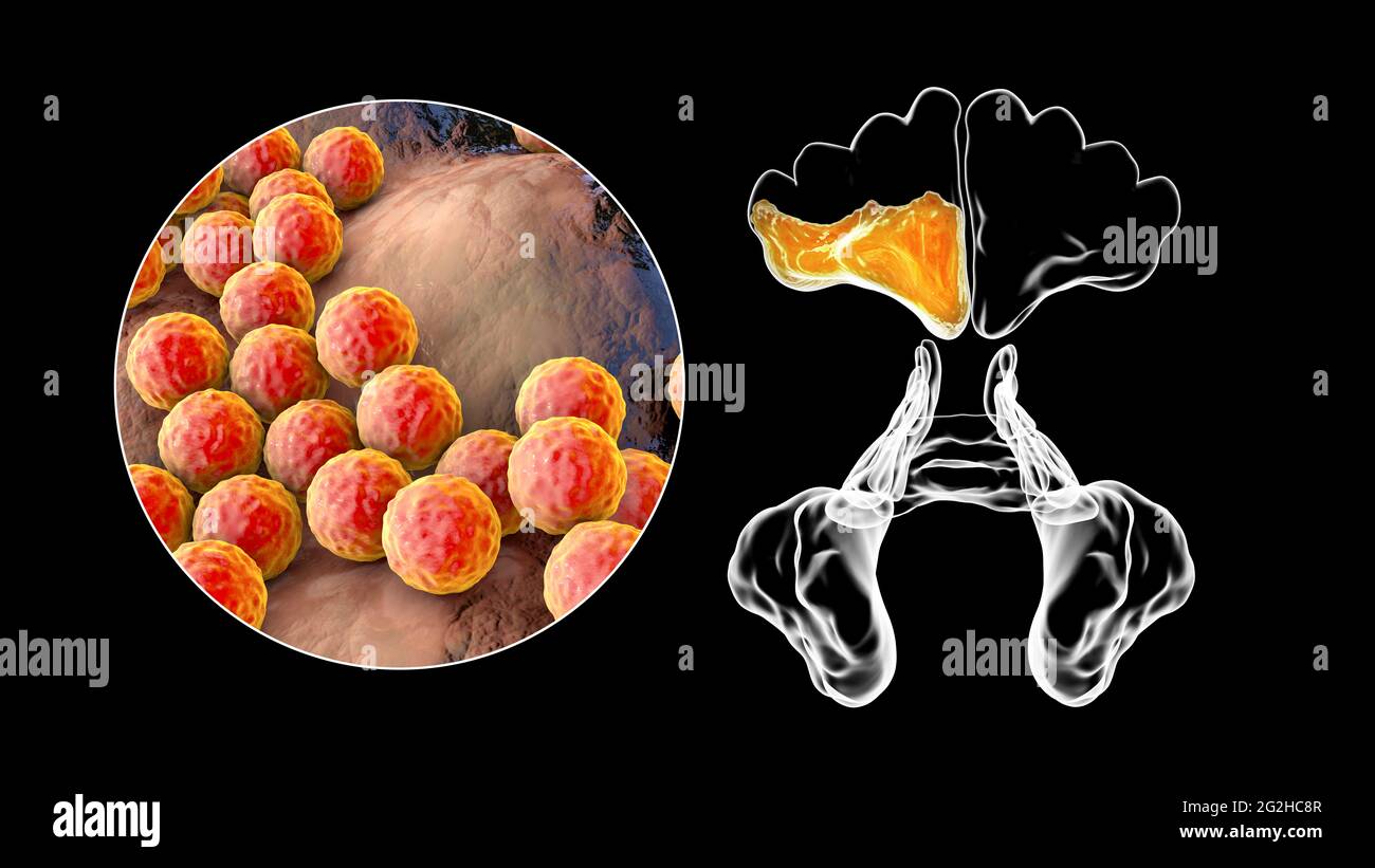 Sinusite, illustration Banque D'Images