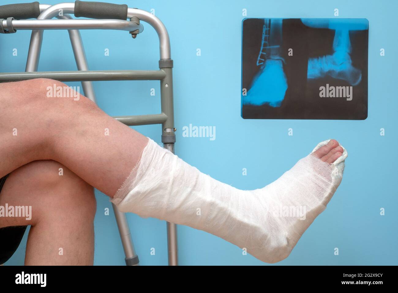 Jambes d'un homme avec une jambe cassée sur un fond bleu. Image à rayons X de la fracture de la cheville , fracture de la cheville , fixation de la fracture de la pott par chirurgie ouverte et plaque métallique Banque D'Images