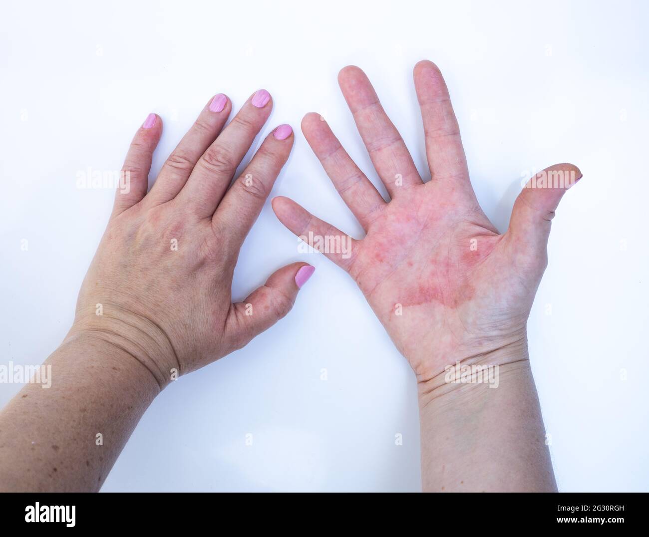 Dermatite atopique, mains rouges, problème dermatologique, mains ...