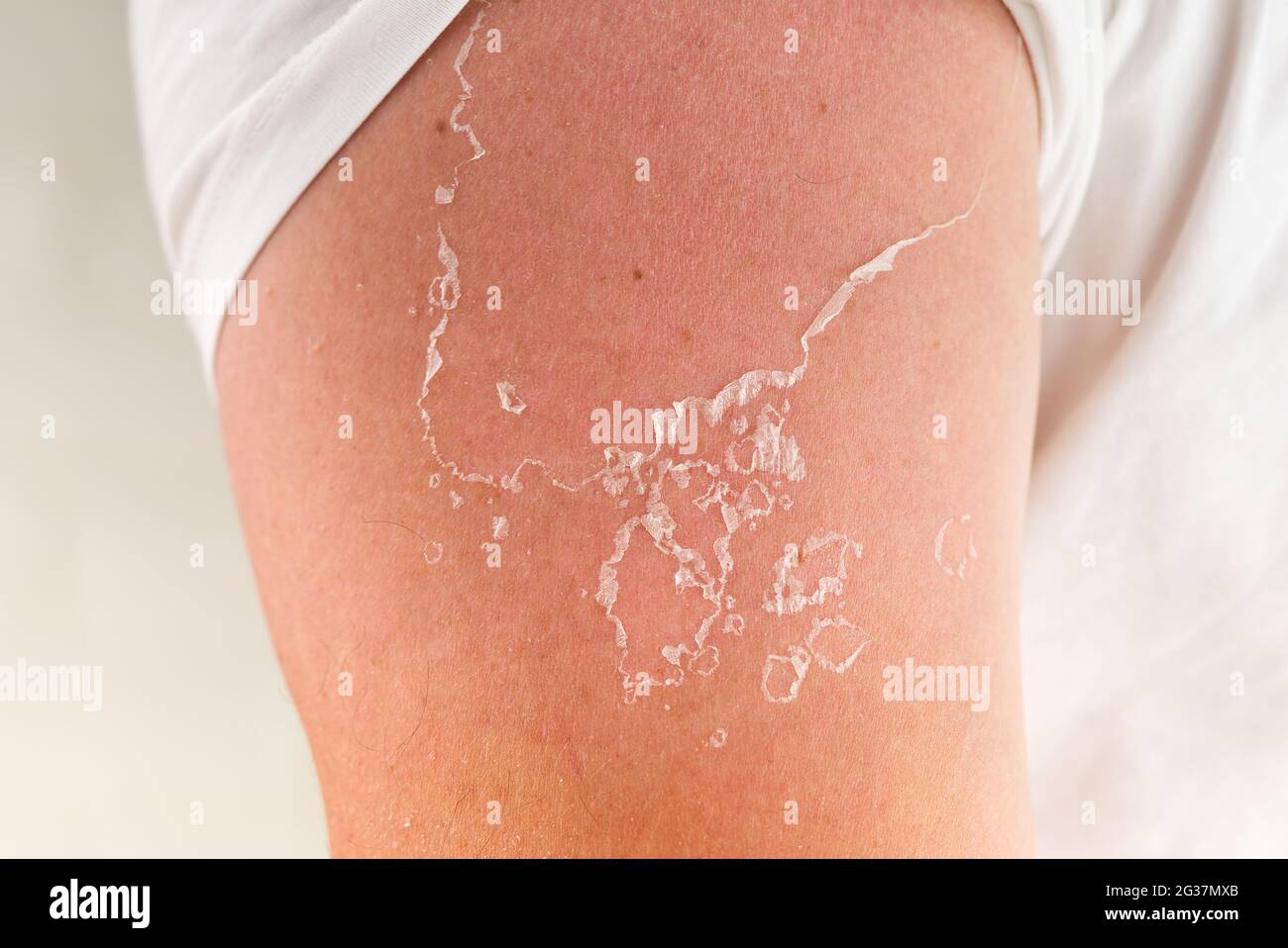 gommage de la peau après brûlure par la lumière du soleil. ne pas utiliser  de crème solaire Photo Stock - Alamy