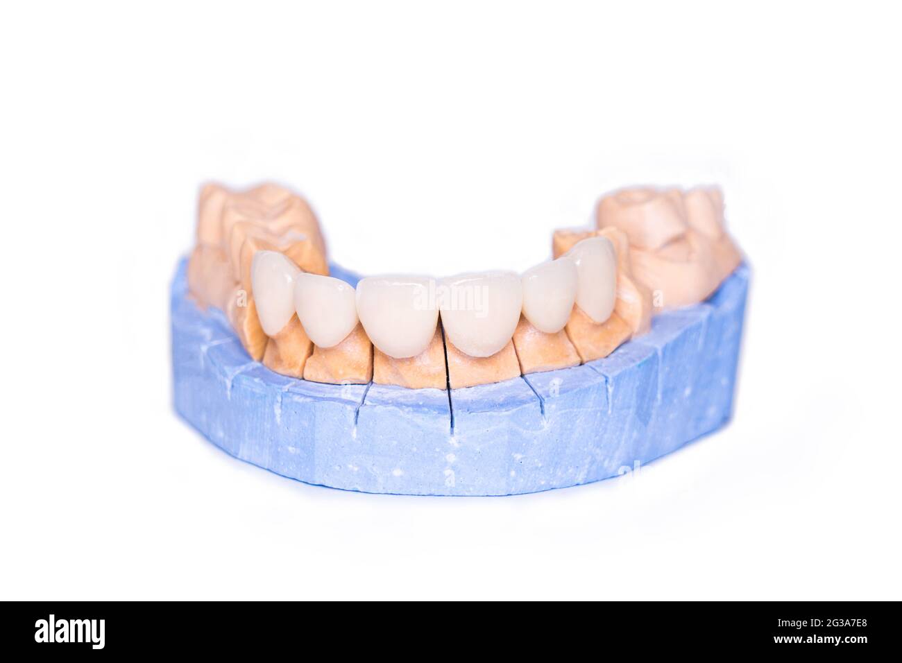 Boiseries et couronnes isolées sur fond blanc. Modèle de plâtre de dents. Modèle de plâtre à mâchoire inférieure avec dents préparées. Plâtre démontable de travail Banque D'Images