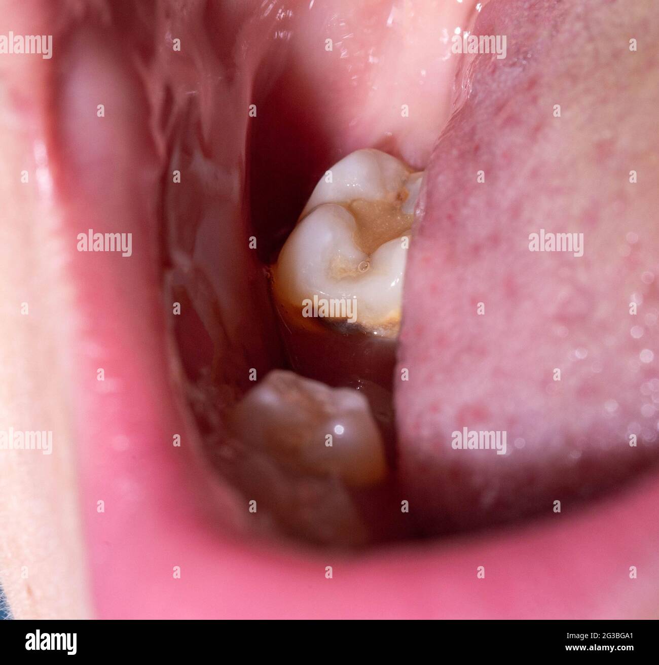 Alvéole dentaire Banque de photographies et d’images à haute résolution Alamy