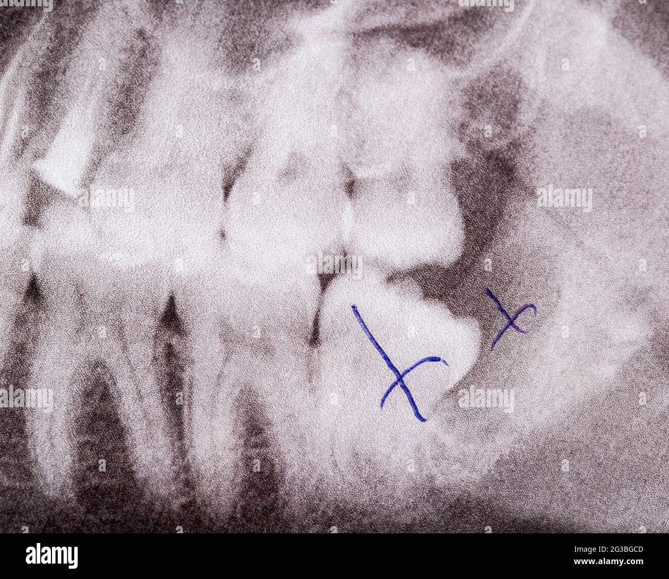 Image des dents par rayons X, retrait de la dent de sagesse et kyste dentaire enflammé, macro. Concept de chirurgie dentaire Banque D'Images