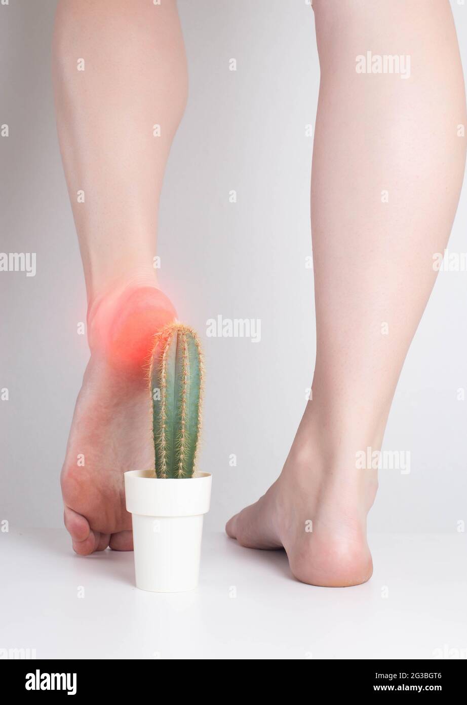 La fille marche sur le cactus avec son pied. Le concept de la douleur dans la semelle et le talon, les troubles métaboliques, la peau fissurée sur les talons Banque D'Images