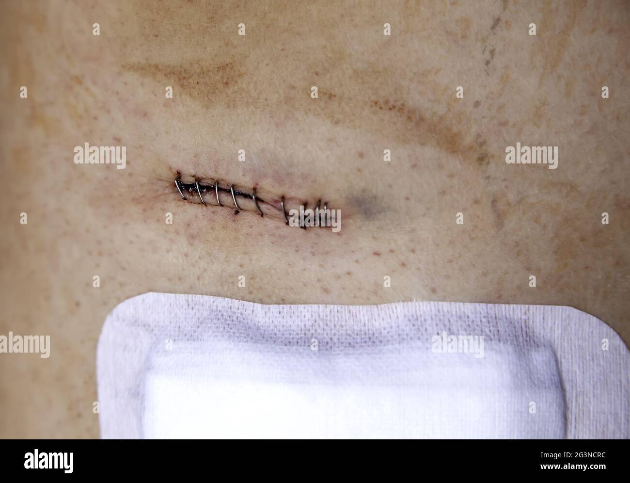 Détail de l'opération médicale, points de suture pour la guérison, post-opératoire Banque D'Images