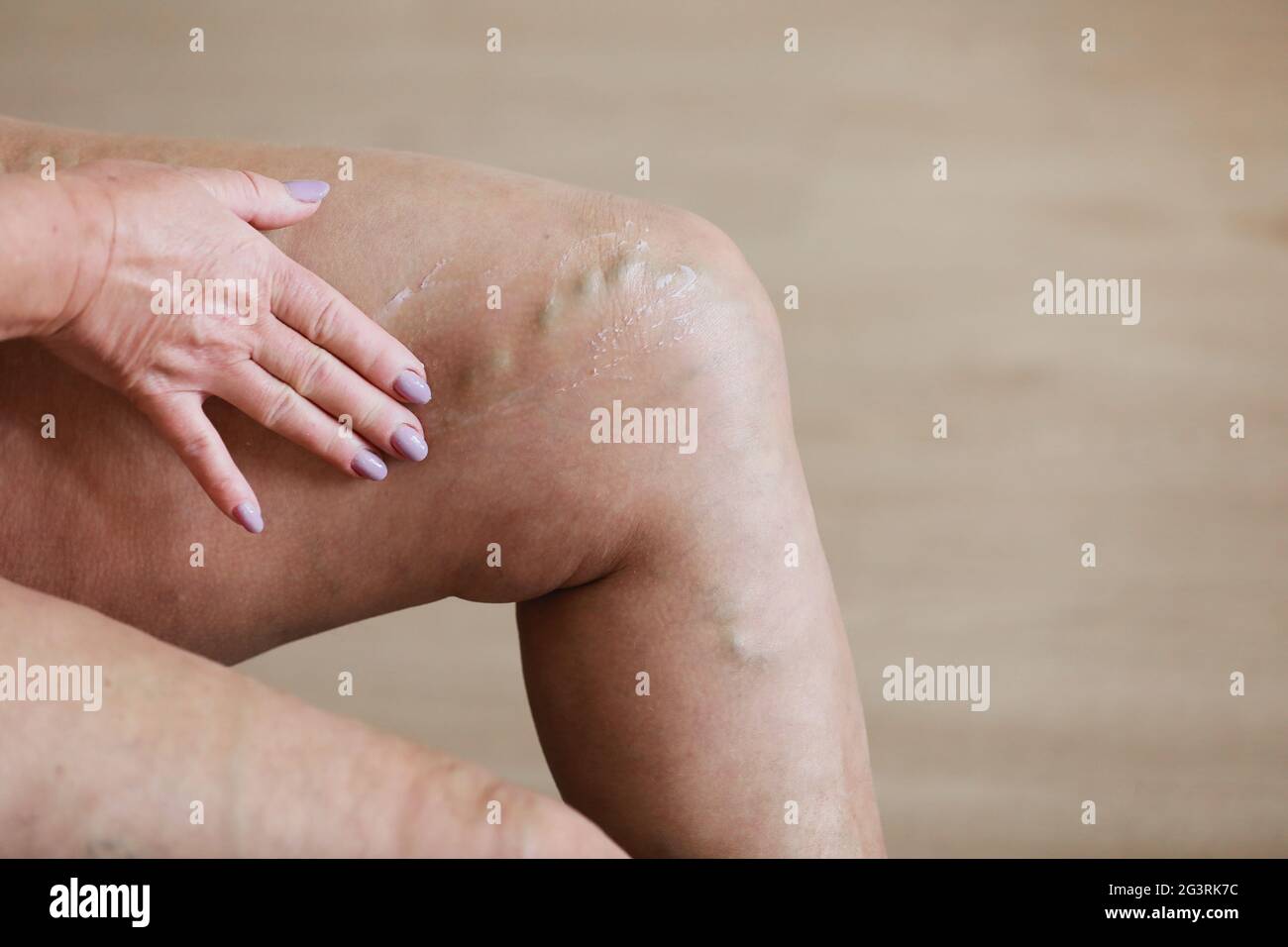 La femme frotte les jambes fatiguées avec une crème spéciale pour réduire la douleur. Phlébologie. Varices douloureuses et des veines araignées sur les jambes actives de la femme, la médecine et la santé Banque D'Images