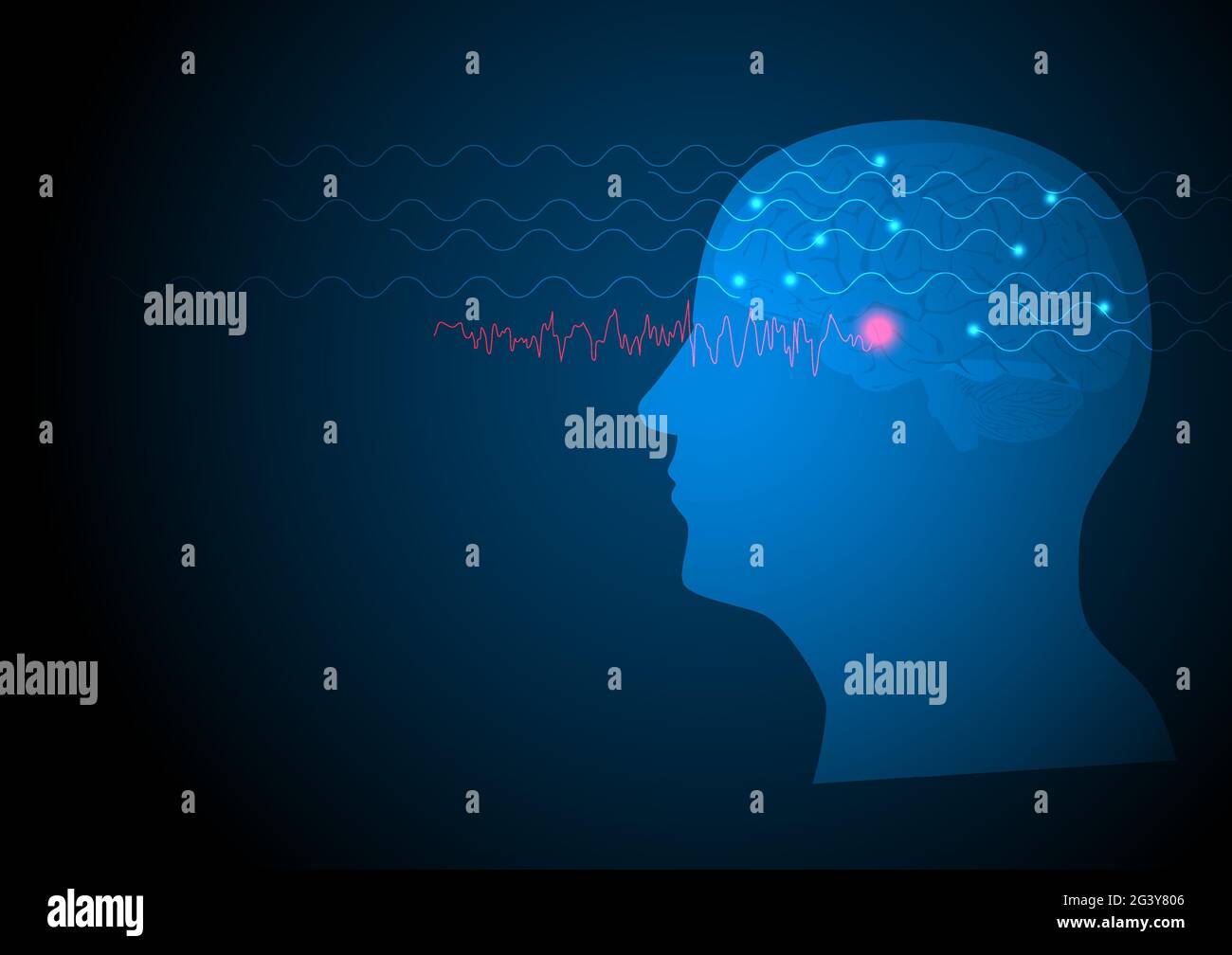 Crise focale. Illustration vectorielle du cerveau humain et de l'électroencéphalograhy ou EEG provenant du lobe temporal. Illustration de Vecteur