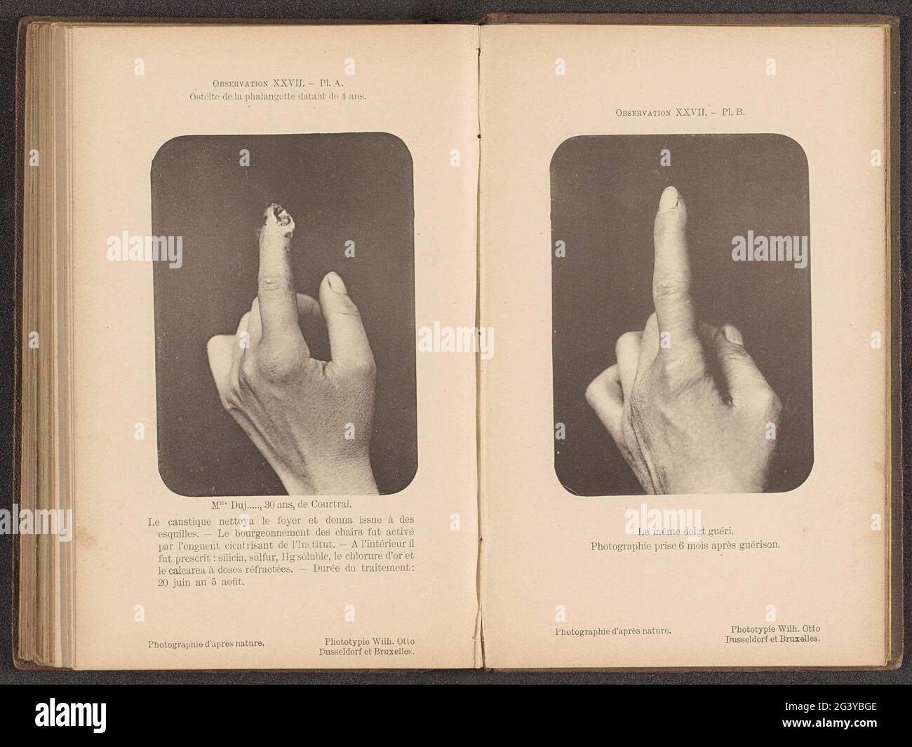 Plaie infectée doigt Banque de photographies et d'images à haute résolution  - Alamy