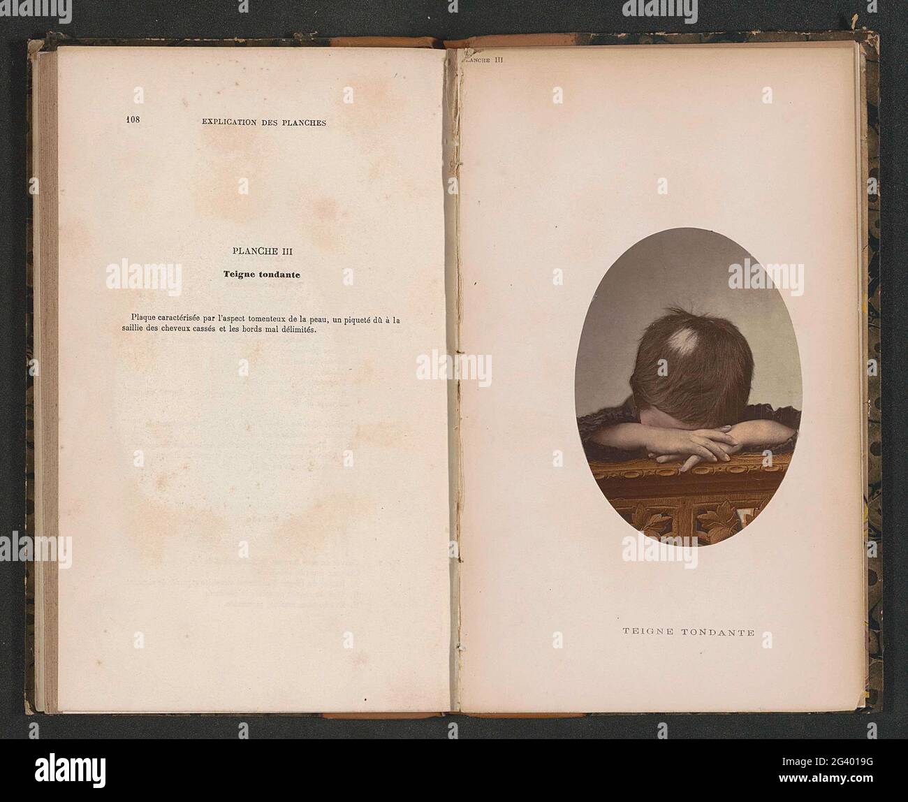 Tache chauve sur la tête d'un enfant causée par la teigne tonlante. . Banque D'Images