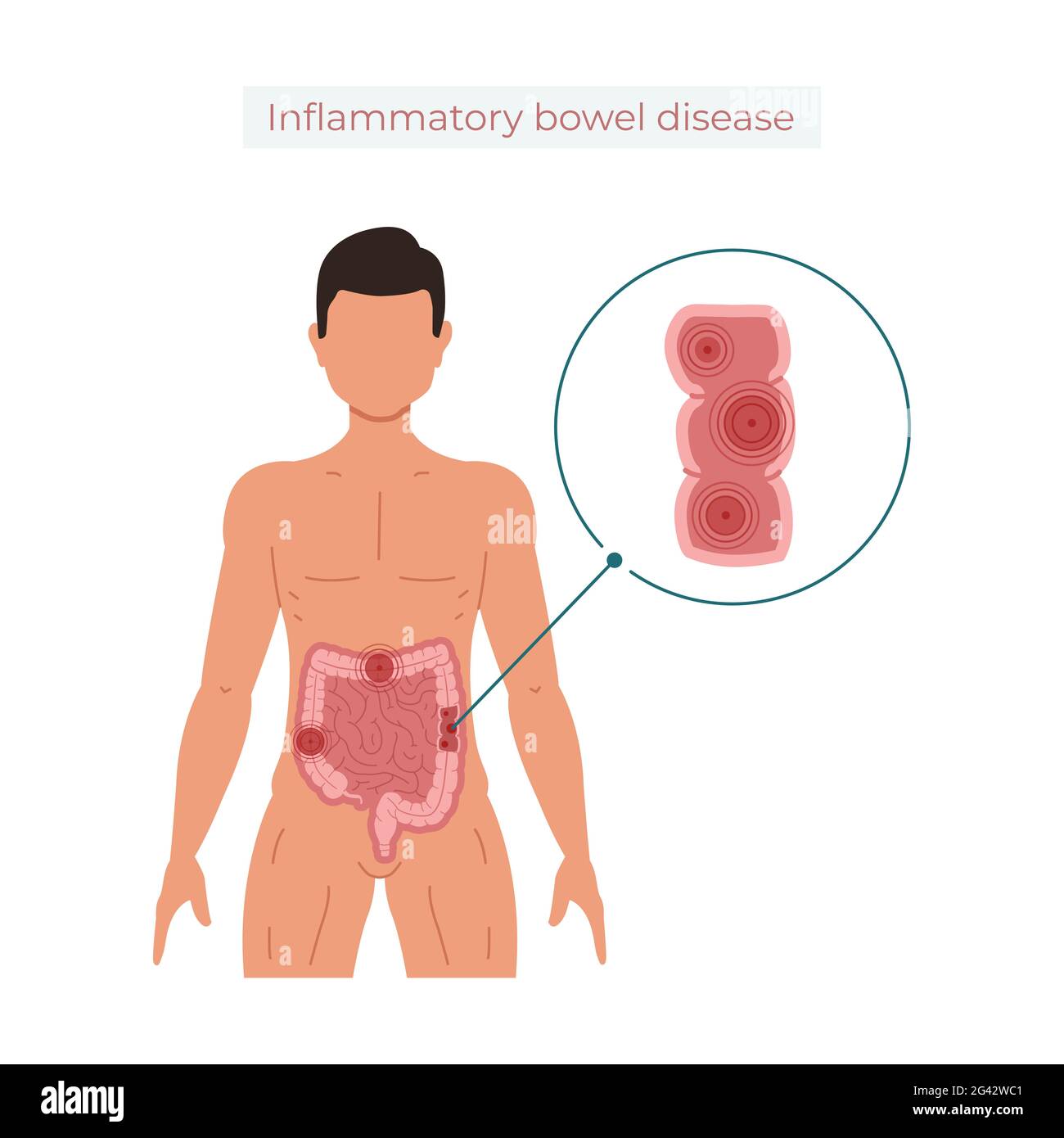 Illustration du vecteur de la maladie inflammatoire de l'intestin isolée sur fond blanc Banque D'Images