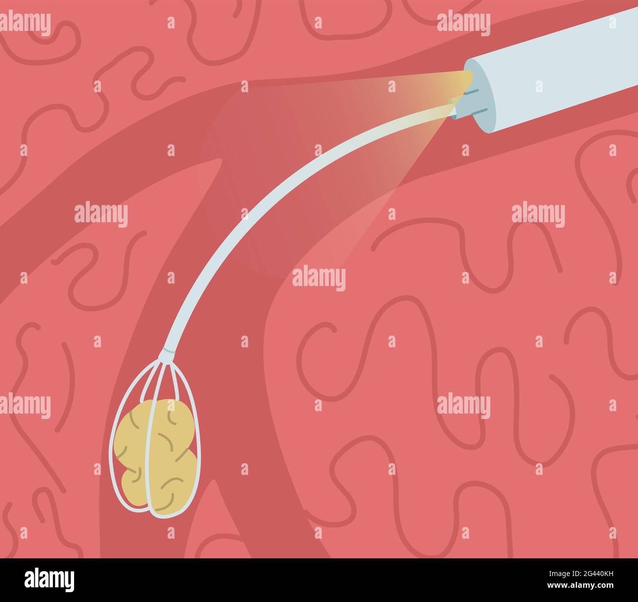 Retrait d'une pierre du conduit de la glande salivaire. Illustration du vecteur de sialendoscopie. Banque D'Images