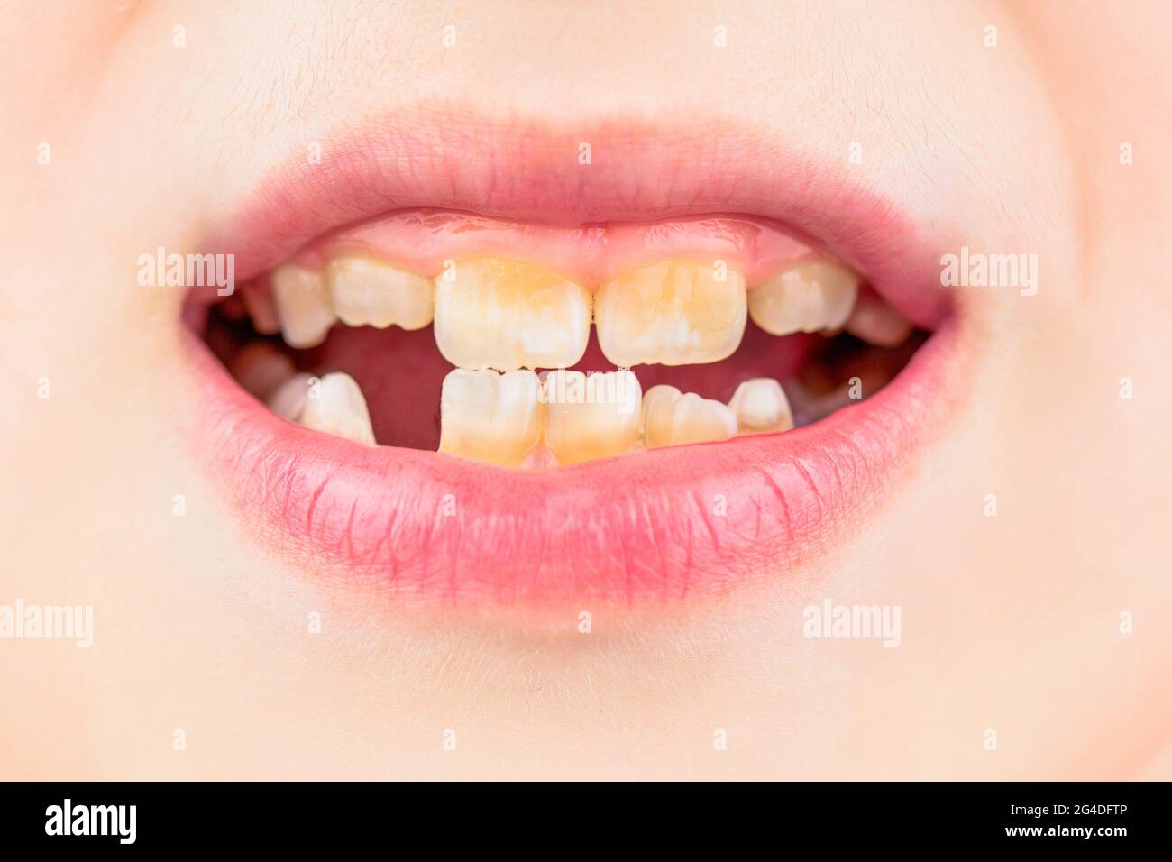 Mauvais Dents Enfant Portrait Garcon Avec De Mauvaises Dents L Enfant Sourit Et Montre Sa Dent De Surpeuplement Gros Plan Sur Les Teths Malsains De Bebe Patient Enfant Bouche Ouverte Photo Stock