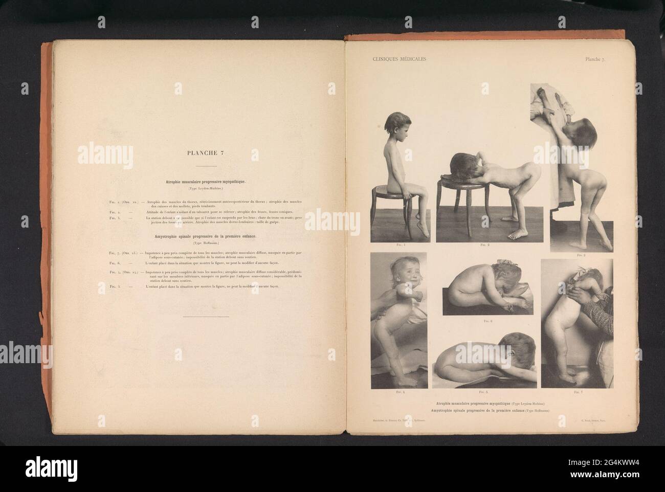 Sept vues des enfants avec l'atrophie musculaire; ATROPHIE MUSCULAIRE