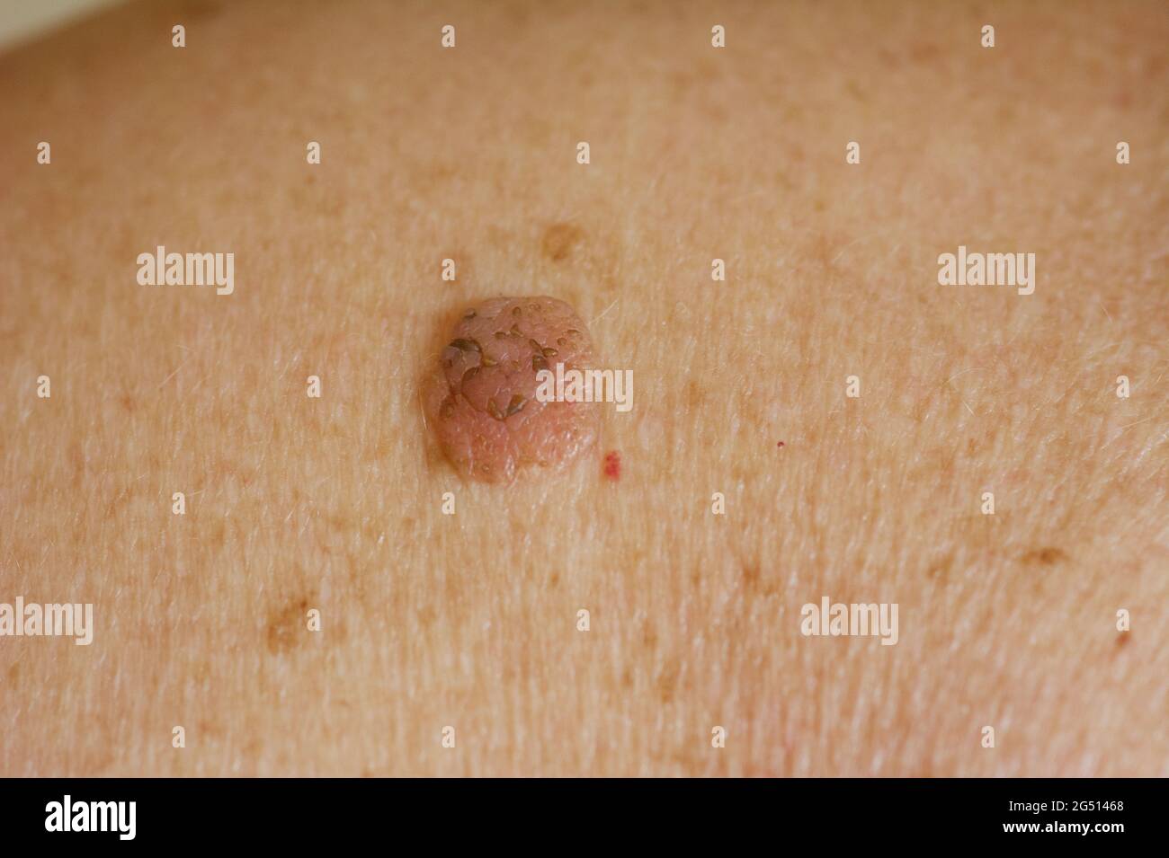 Gros plan de la mole sur la peau humaine Banque D'Images