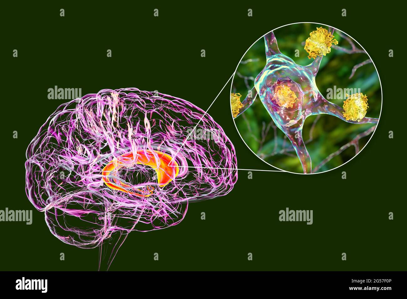 Inclusions neuronales dans la maladie de Huntington, illustration Banque D'Images