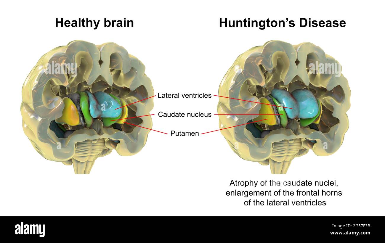 Cerveau et cerveau normaux dans la maladie de Huntington, illustration Banque D'Images