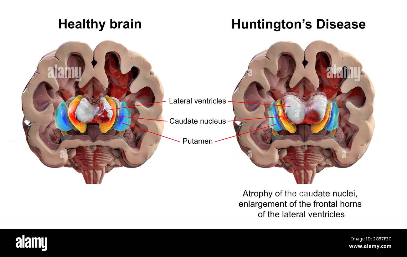 Cerveau et cerveau normaux dans la maladie de Huntington, illustration Banque D'Images