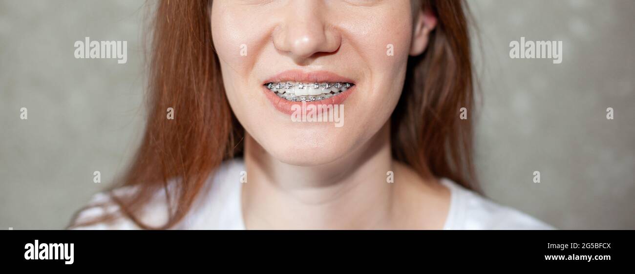 Le sourire d'une jeune fille avec des bretelles sur ses dents blanches. Redressage des dents. Banque D'Images