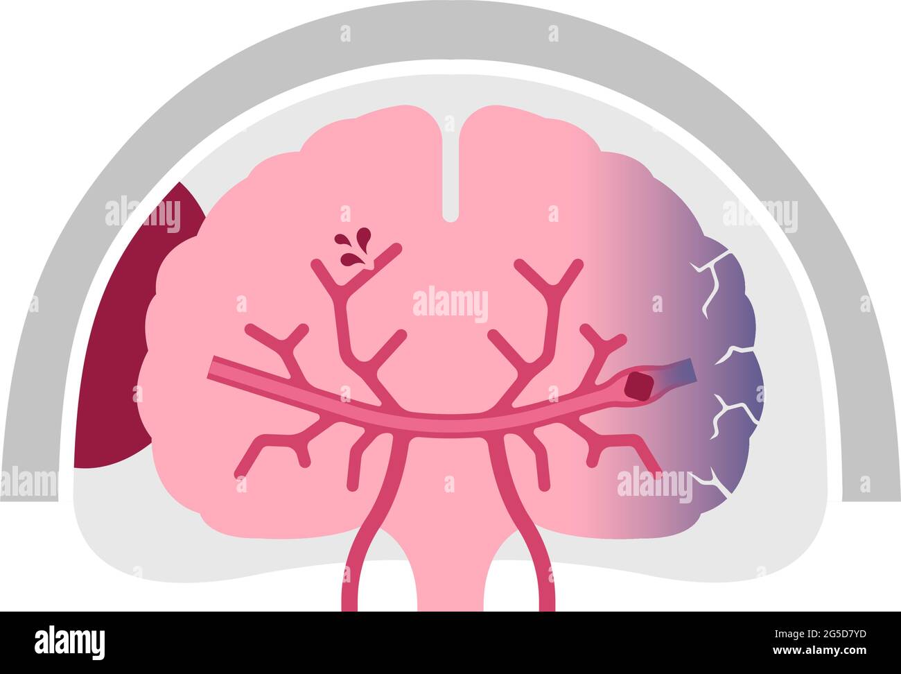 Types d'illustration de vecteur d'AVC cérébral humain Illustration de Vecteur