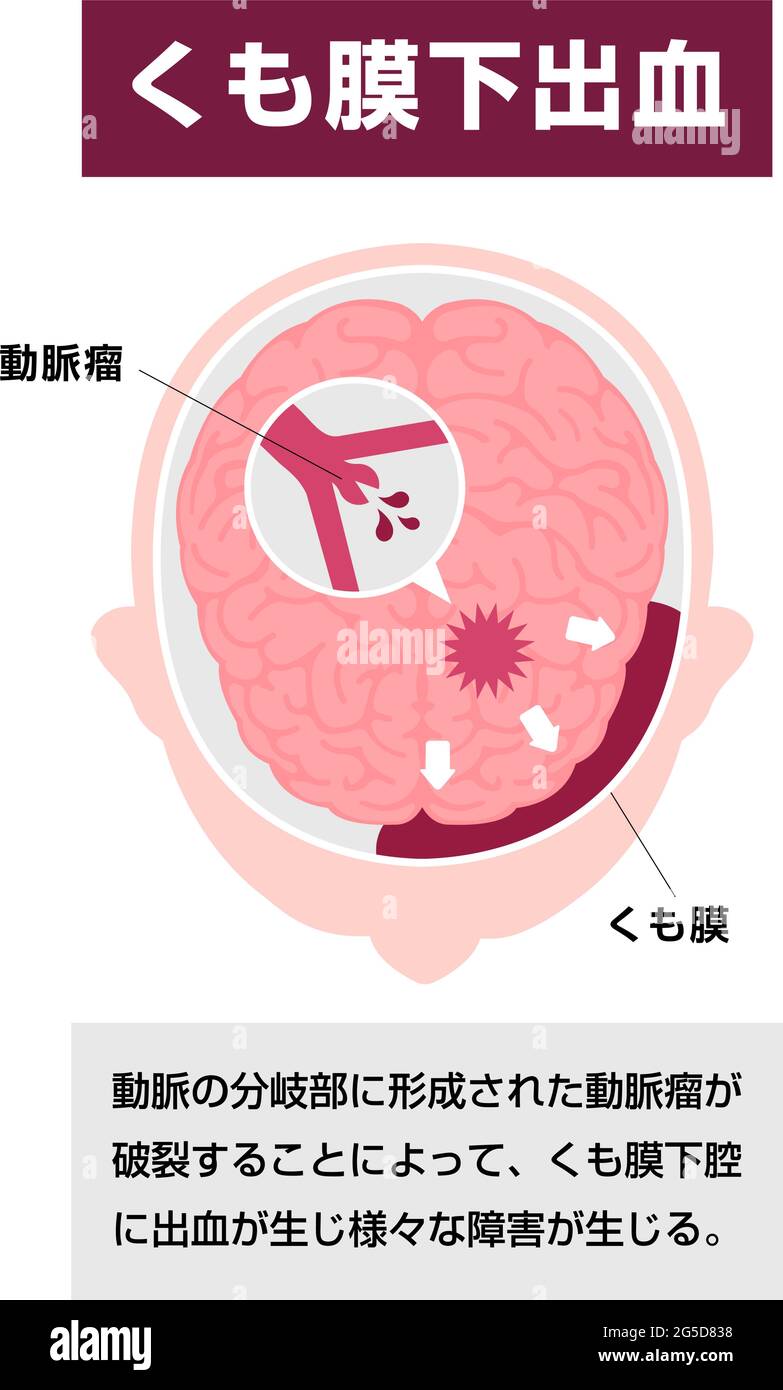 Types d'illustration du vecteur d'AVC cérébral humain | hémorragie sous-arachnoïdienne Illustration de Vecteur