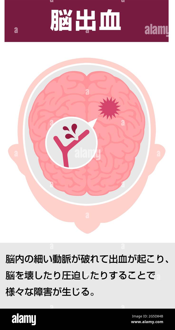 Types d'illustration de vecteur d'AVC cérébral humain | hémorragie cérébrale Illustration de Vecteur