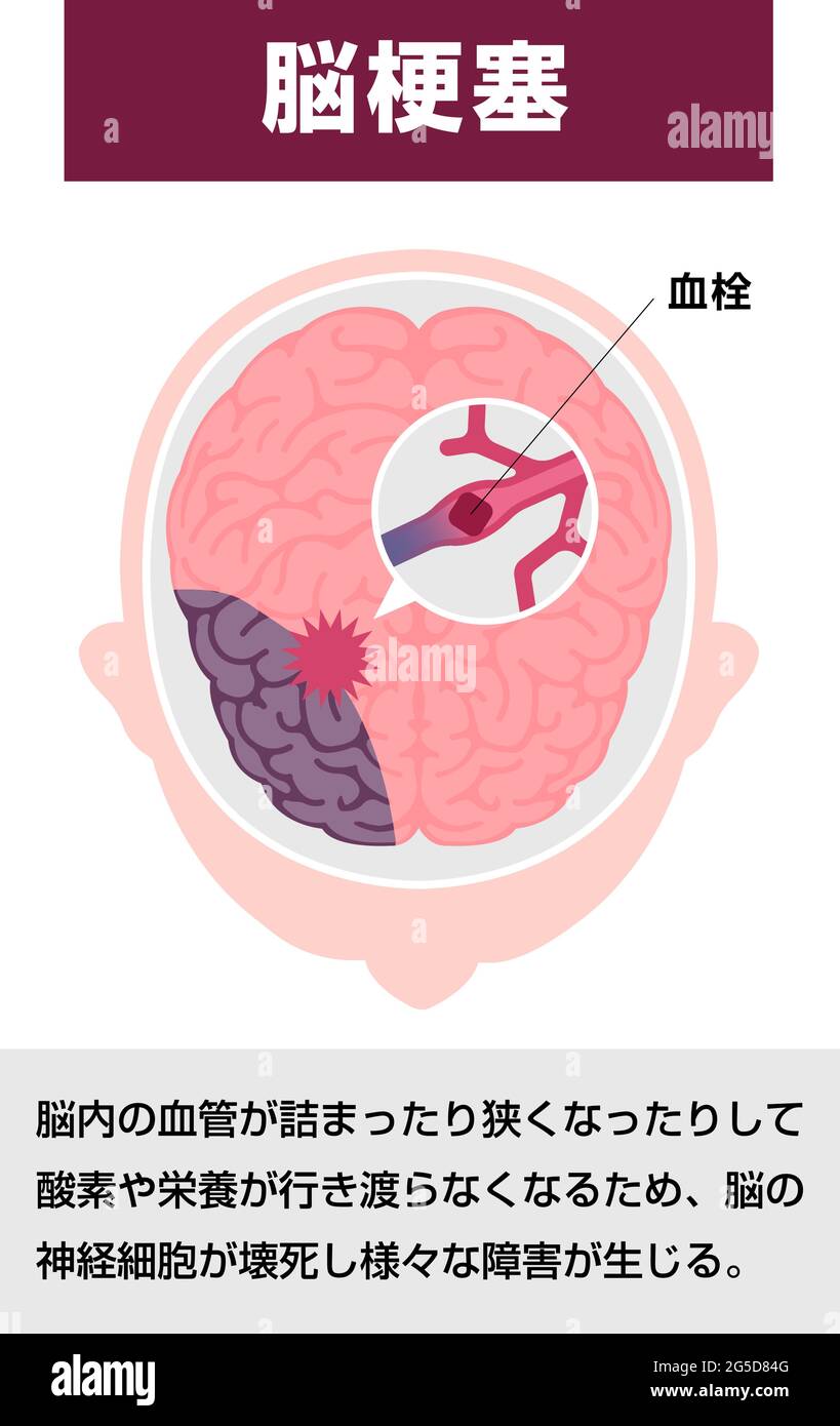 Types d'illustration de vecteur d'AVC cérébral humain | infarctus cérébral Illustration de Vecteur