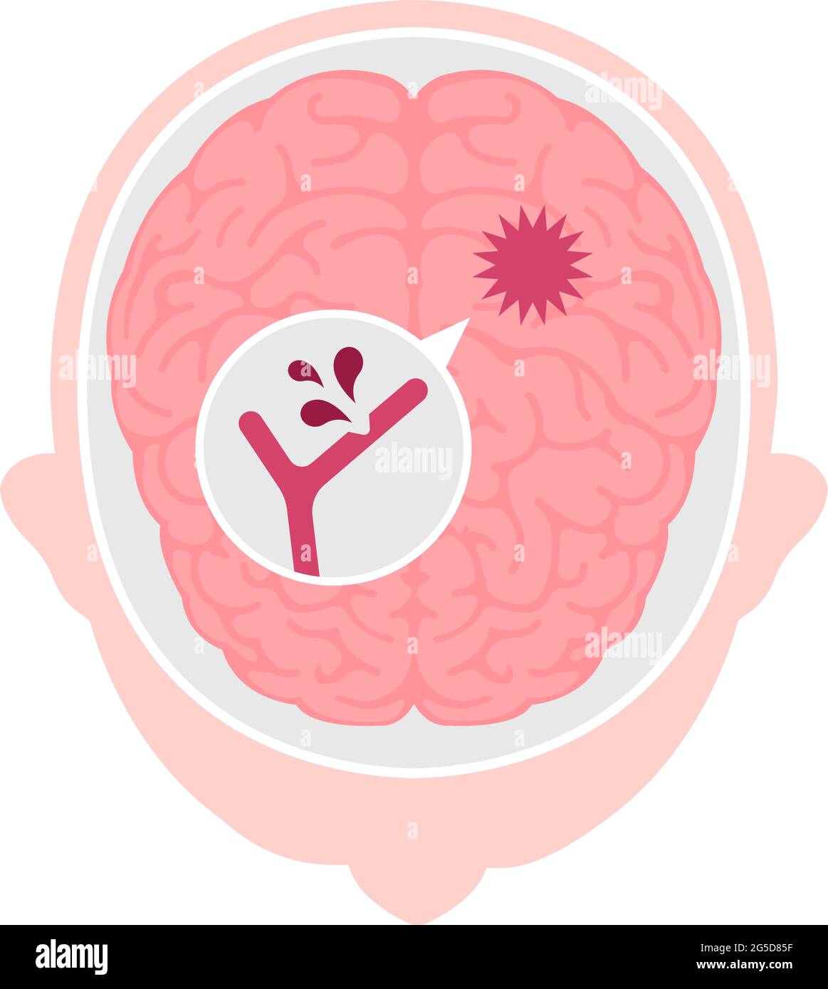 Types d'illustration de vecteur d'AVC cérébral humain | hémorragie cérébrale Illustration de Vecteur