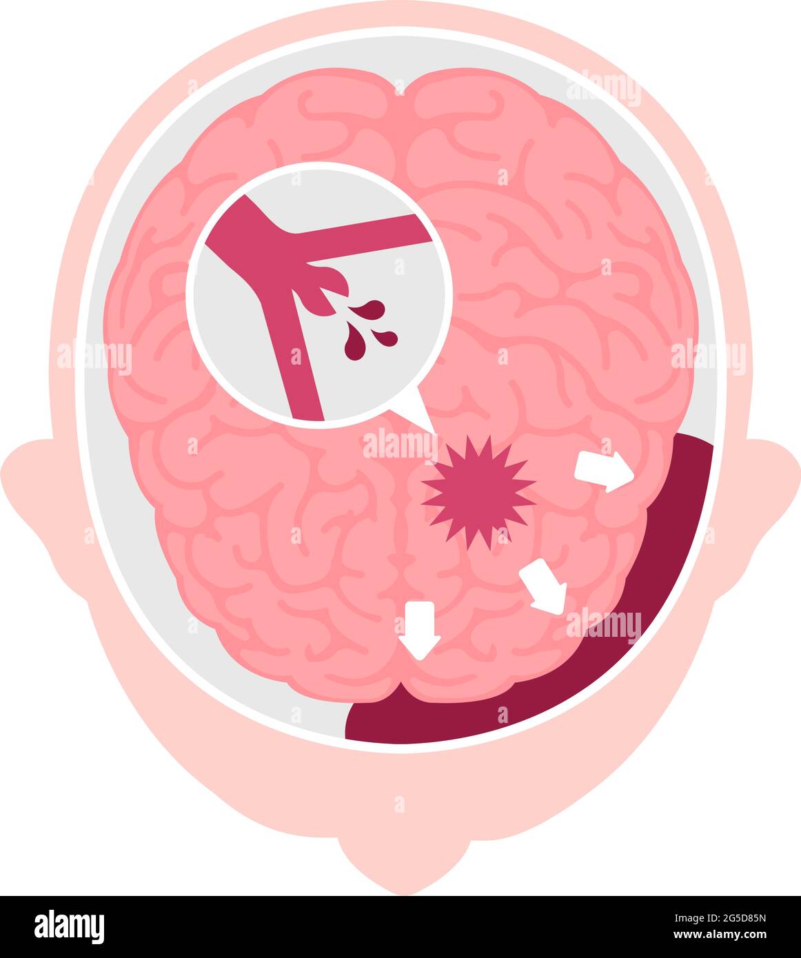 Types d'illustration du vecteur d'AVC cérébral humain | hémorragie sous-arachnoïdienne Illustration de Vecteur