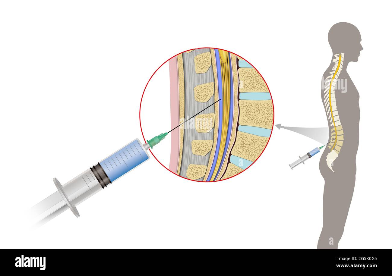 La ponction lombaire, également connue sous le nom de robinet spinal, est une procédure médicale dans laquelle une aiguille est insérée dans le canal spinal. Liquide céphalo-rachidien Banque D'Images