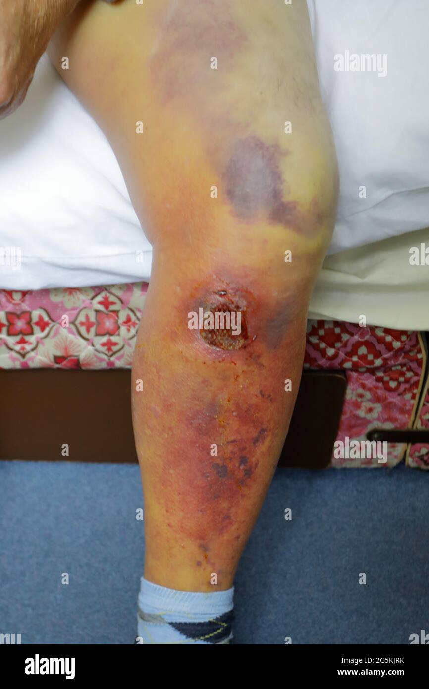 jambe humaine, montrant les ecchymoses (contusiona, hématome) une semaine après avoir été frappé par une balle de cricket (traumatisme émoussé) Banque D'Images