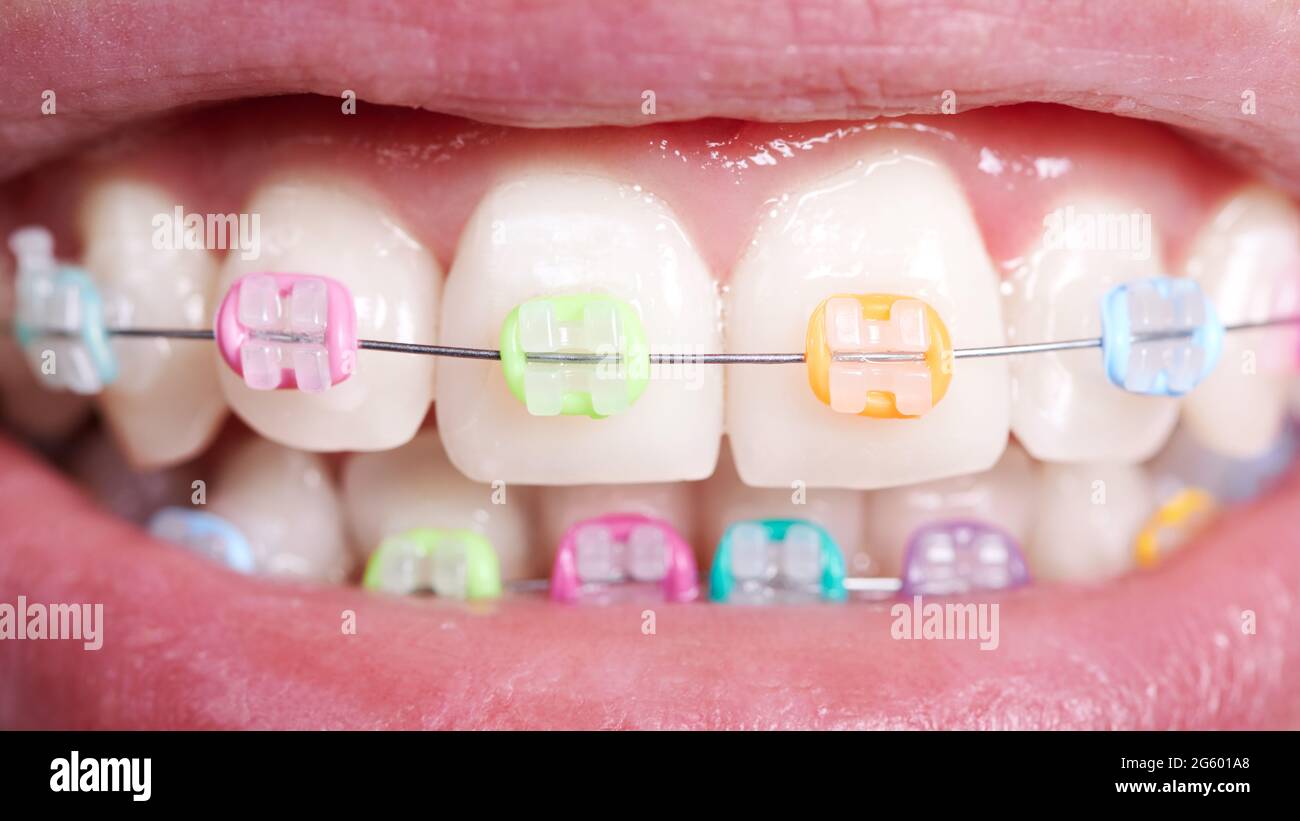 Gros plan des bretelles orthodontiques avec bandes en caoutchouc colorées sur les dents. Personne faisant la démonstration de supports câblés avec anneaux dentaires multicolores. Concept de den Banque D'Images