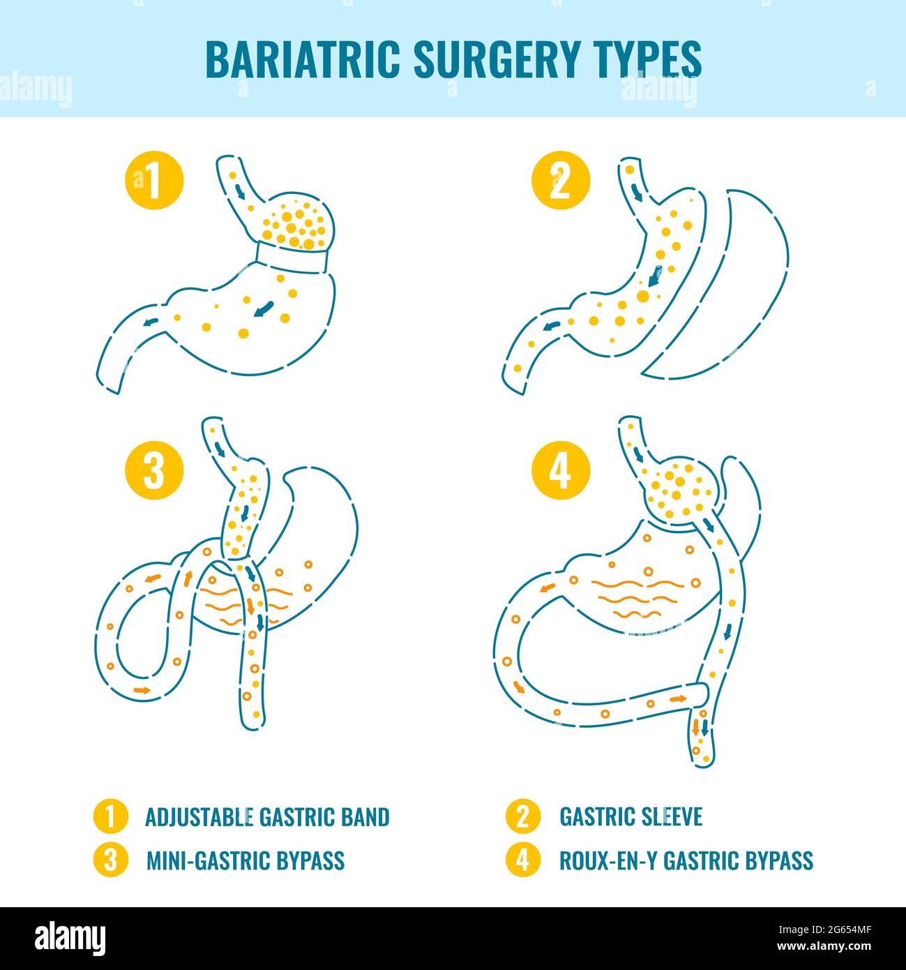 Types de chirurgie bariatrique, illustration Photo Stock - Alamy