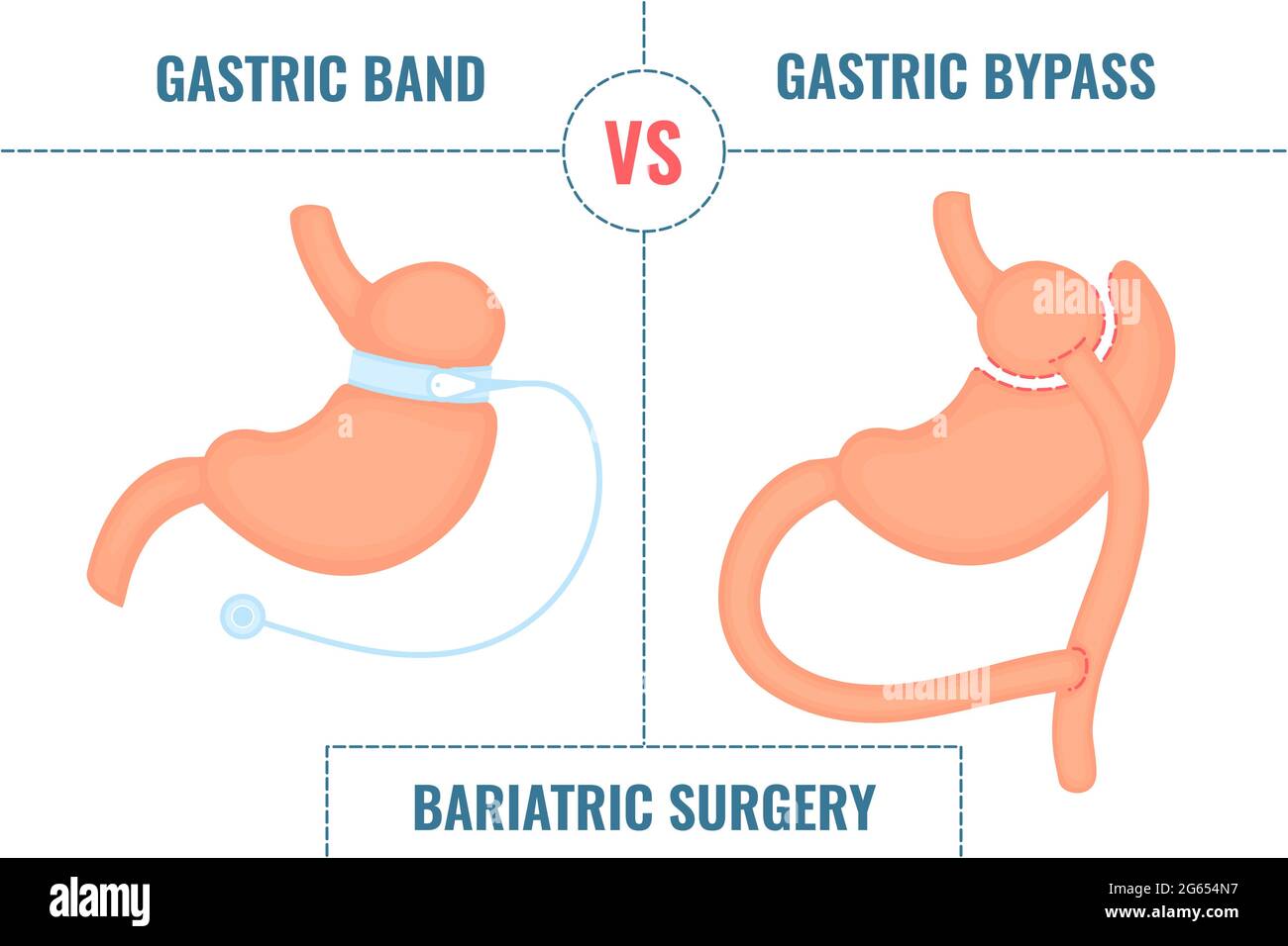 Bande gastrique vs dérivation gastrique, illustration Banque D'Images