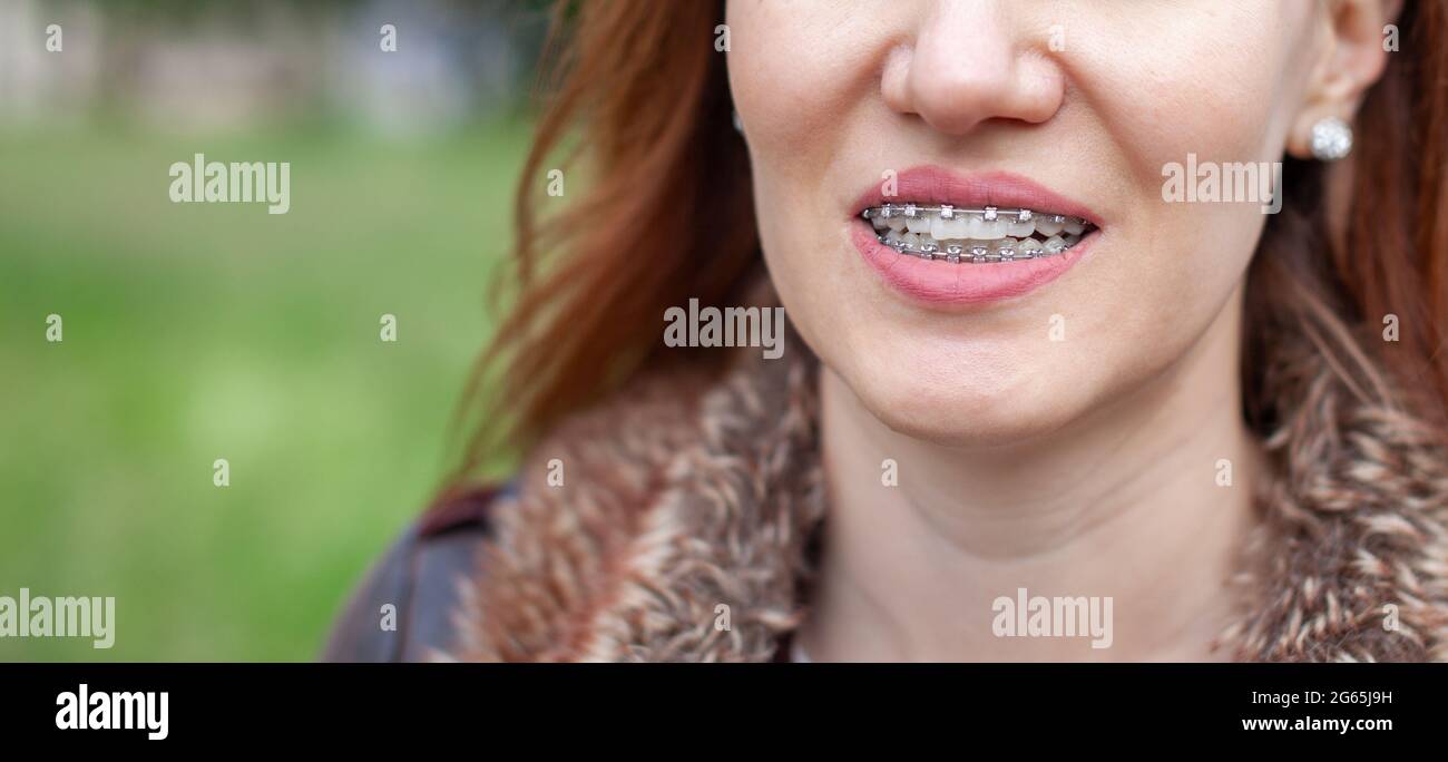 Le sourire d'une jeune fille avec des bretelles sur ses dents blanches. Redressage des dents. Malocclusion. Soins dentaires. Banque D'Images