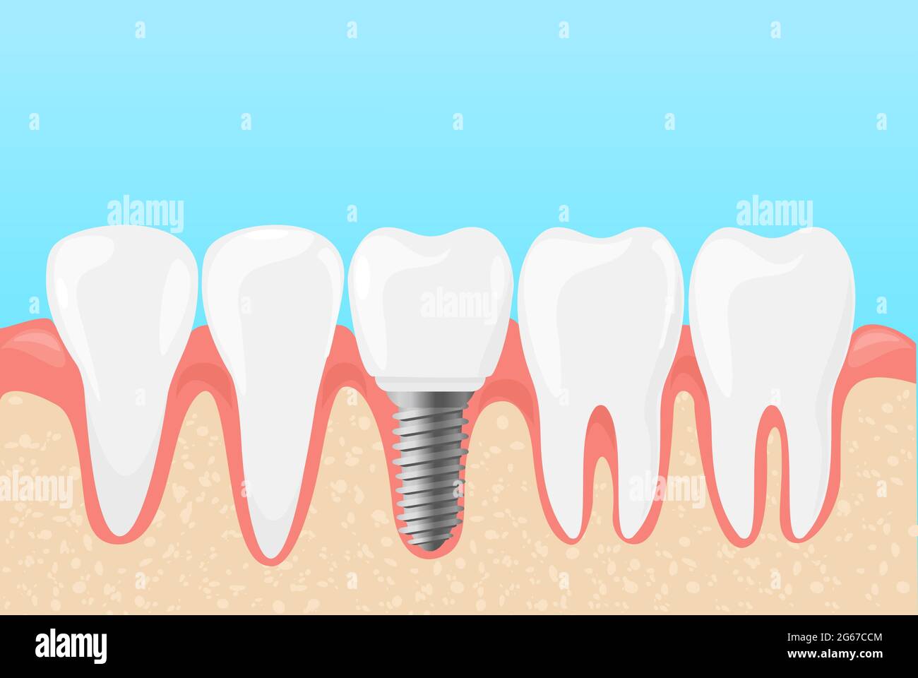 Illustration vectorielle des dents humaines et de l'implant dentaire. Médecine dentistes concept de soins des dents dans le style de dessin animé plat. Illustration de Vecteur
